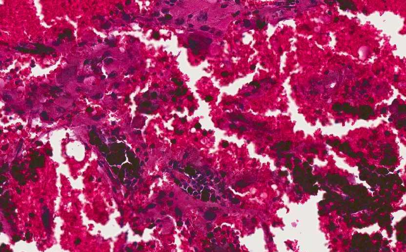 PXA with anaplastic features