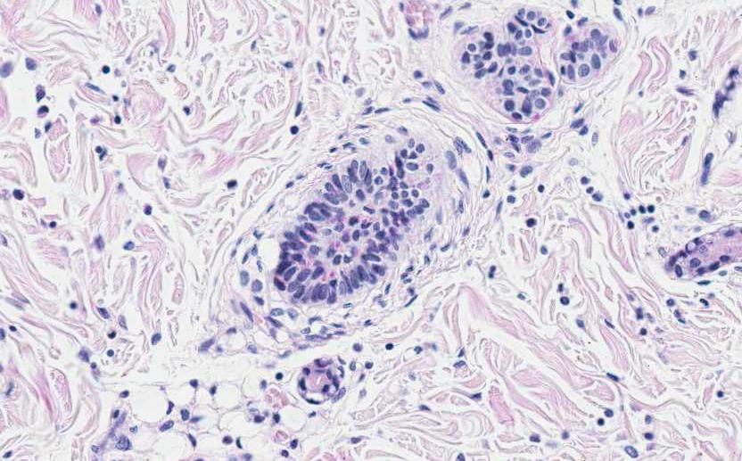 Glycogen storage disease type IV