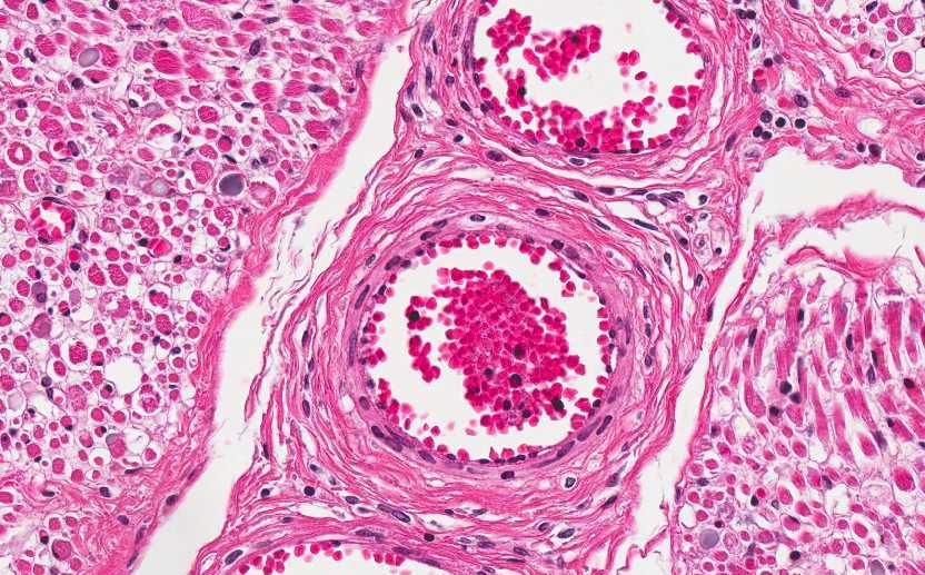 Glycogen storage disease type IV